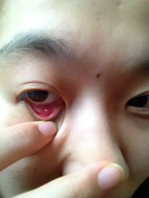 眼睛下眼睑内长了一个肉疙瘩,不痛不痒.用手能摸得到.求帮助!