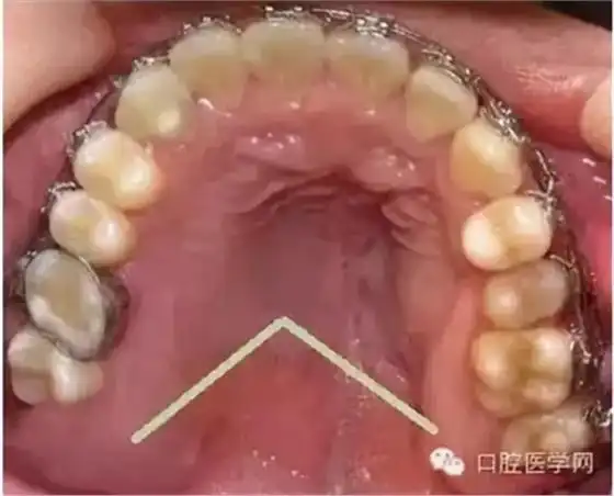 并不是一个疾病症状,也不是疾病的表现,比如舌侧骨隆突,上颌骨骨隆突