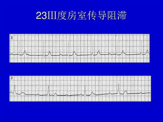 23Ⅲ度房室传导阻滞