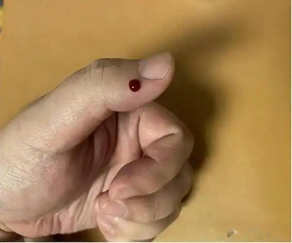 【中医穴位养生】刺几滴血,咽喉肿痛消失了,还有退热功效!