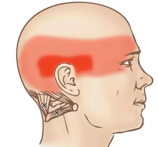 后脑勺疼痛要警惕四种疾病 后脑勺疼痛的原因