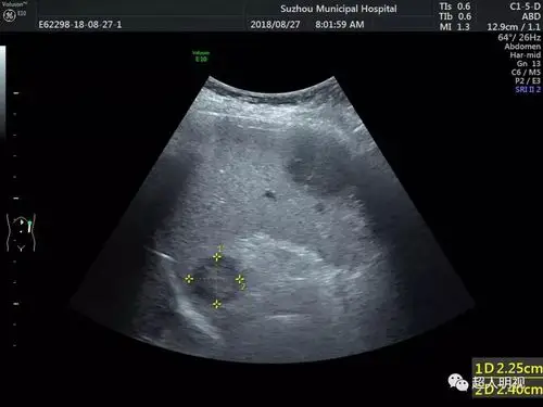 77淋巴瘤是脾脏中最常见的原发性恶性肿瘤,因为它是淋巴系统的一