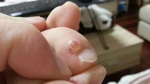 脚趾上起了个水泡,不痛不痒,挤破后会有粘稠的黄色液体流出.