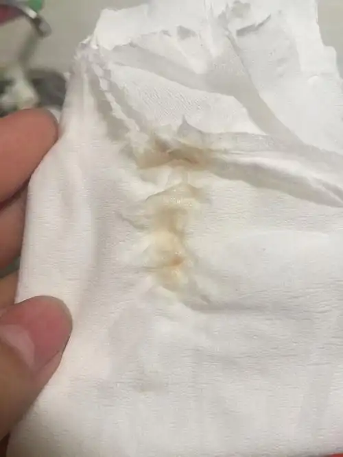 人流后三天后排出来这样的东西,也不是血,想知道,这是怎么了