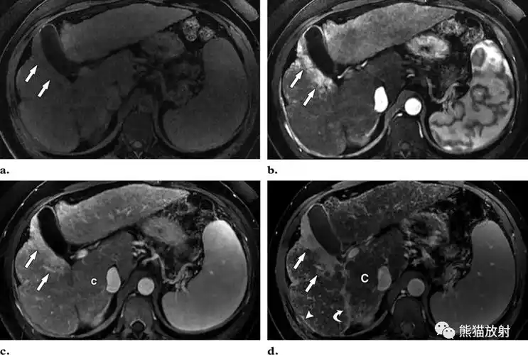 肝纤维化丨mr成像方法及表现_脂肪_门脉_显示