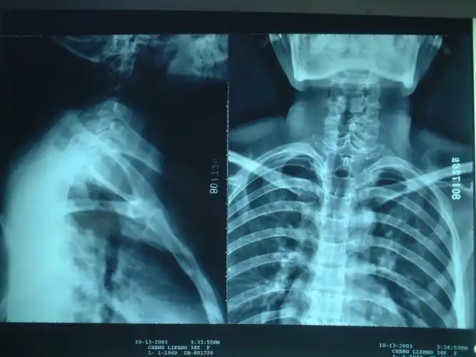 胸椎1-3病变,请教