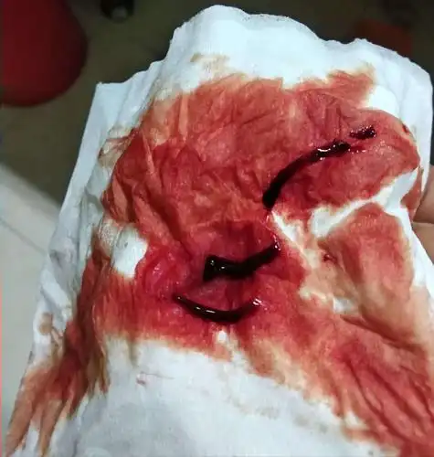 月经只有两三天,正常吗?正常的月经是怎样的?