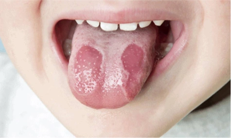 怎么判断宝宝是不是有地图舌