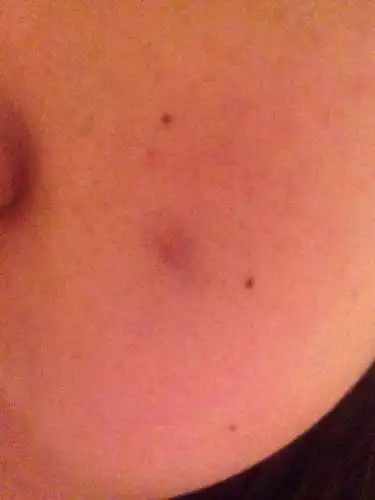 长了一个疙瘩,不疼不痒,似乎是传说的粉瘤,开始很大,现在变小很多,看