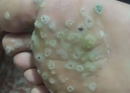 你可能得了"跖疣"阿哦~走路还疼得不行一颗一颗又一颗结果脚上长了