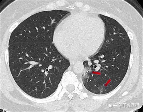 肺部点状钙化影