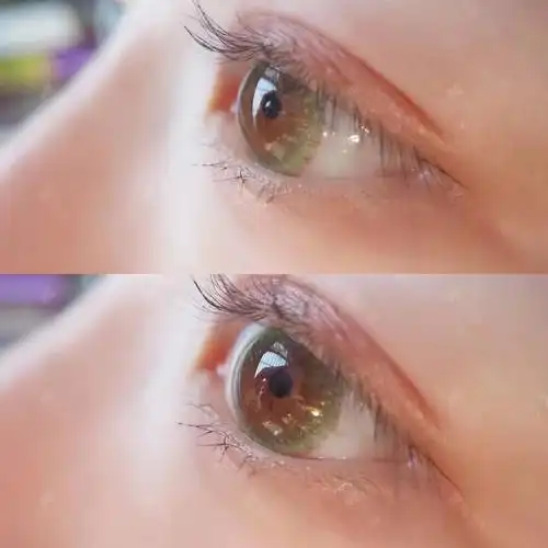 " 双眼皮 "怎么做更好看?_容猫医美