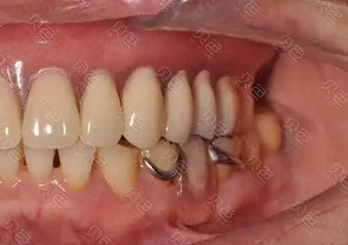 种半口牙好还是戴半口假牙好种植牙和假牙优缺点详解