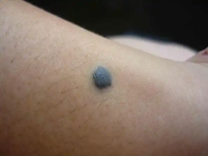 这个痣有危险么