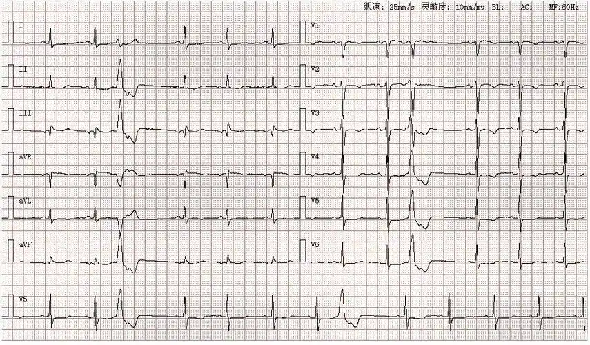 心电图图谱 4如图所示,p波在Ⅰ,Ⅱ,avf,v4-v6导联直立向上,avr导联