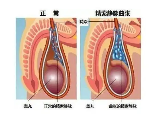 拉萨精索静脉曲张医院_拉萨治疗精索静脉曲张哪家医院好