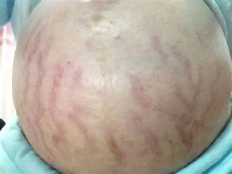 妊辰纹修复的好处妊辰纹2022已更新今日图集