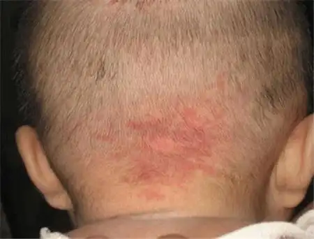 新生儿斑痣和鲜红斑痣的区别