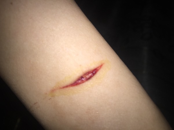 胳膊被割伤了,需要缝针么?如果不缝针会落疤么?急