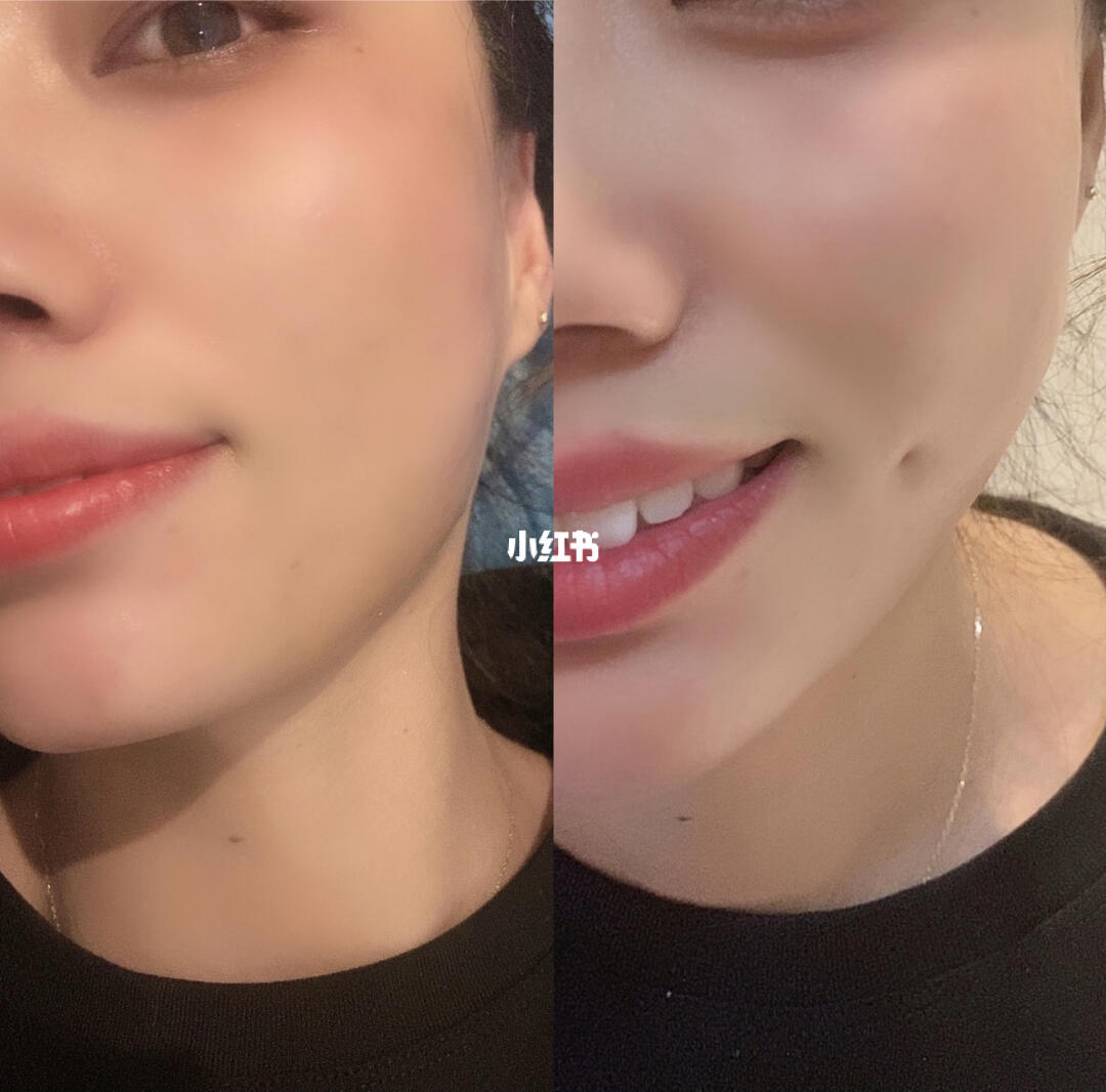 梨涡再造梨涡术