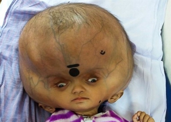 男孩患病头部肿胀如西瓜:治疗后头围缩26厘米