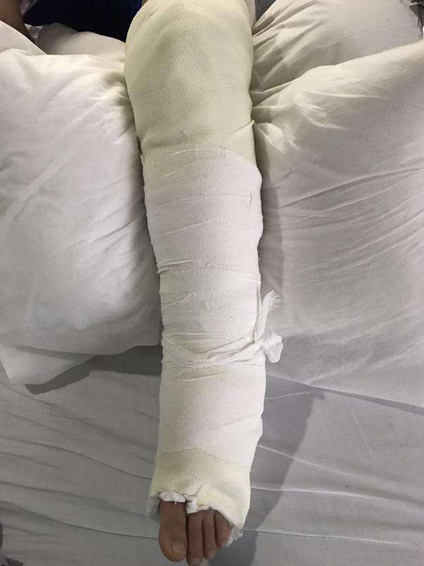 石膏固定后注意事项