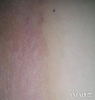 【图】大腿内侧黑色素沉淀是怎么回事呢 去掉色素有效的方法