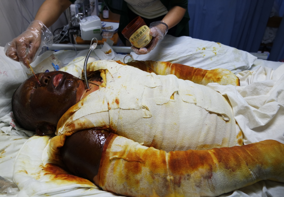 乐从出租屋煤气爆炸致全身重度烧伤92% 急需救命钱