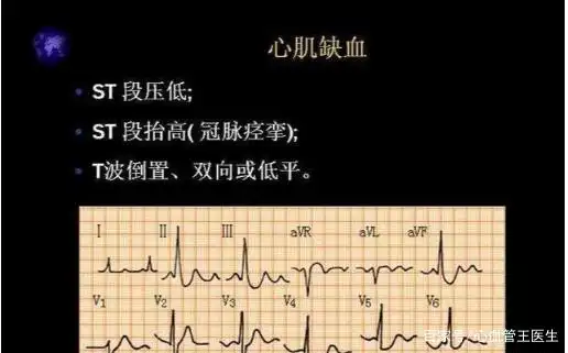 20岁女生心电图提示心肌缺血!这可怎么办?医生看完她放心了