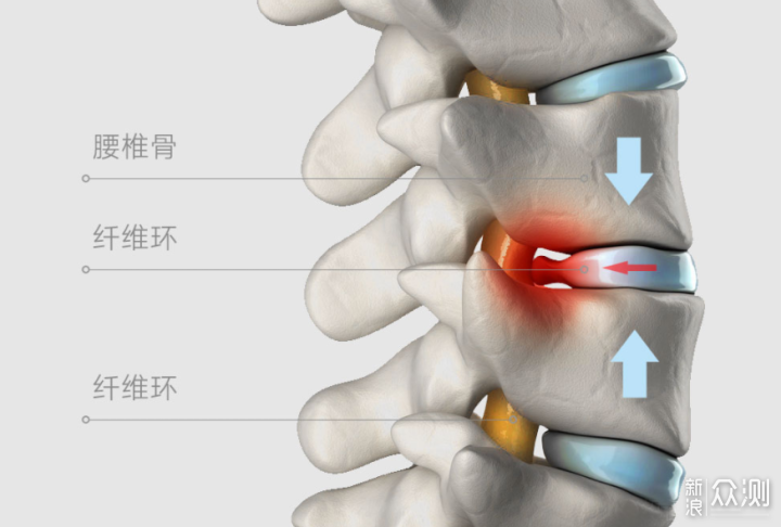 站起来腰痛难忍,这是因为长时间坐着腰椎骨压迫纤维环刺激腰椎神经
