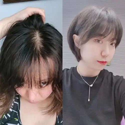 狼疮脱发小妹换了发型师后