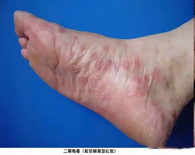 关于男生梅毒真实照片的图片及评论