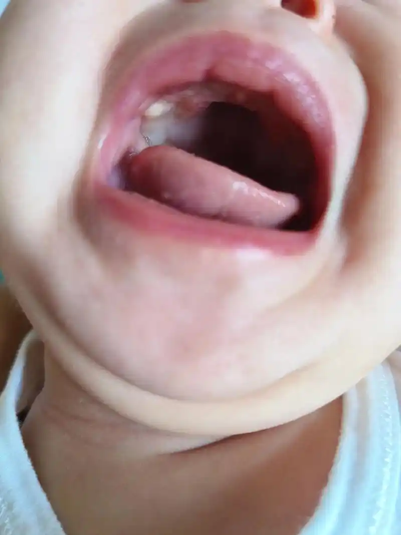 这几天发现宝宝上牙龈大牙位置有这个白色的小包,摸 - 抖音
