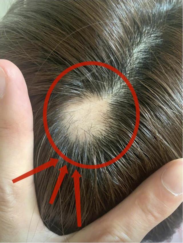 沈梦辰晒斑秃照上热搜头顶秃了一大块连男友杜海涛都曾嘲笑她是裘千仞