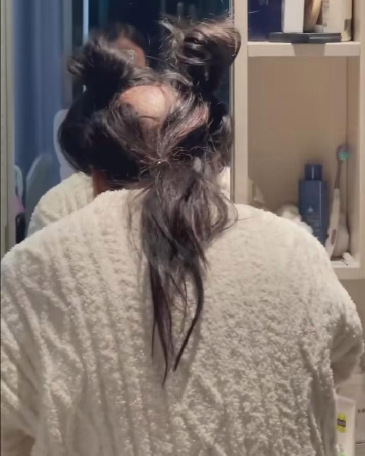 女生也会秃顶吗?无法理解