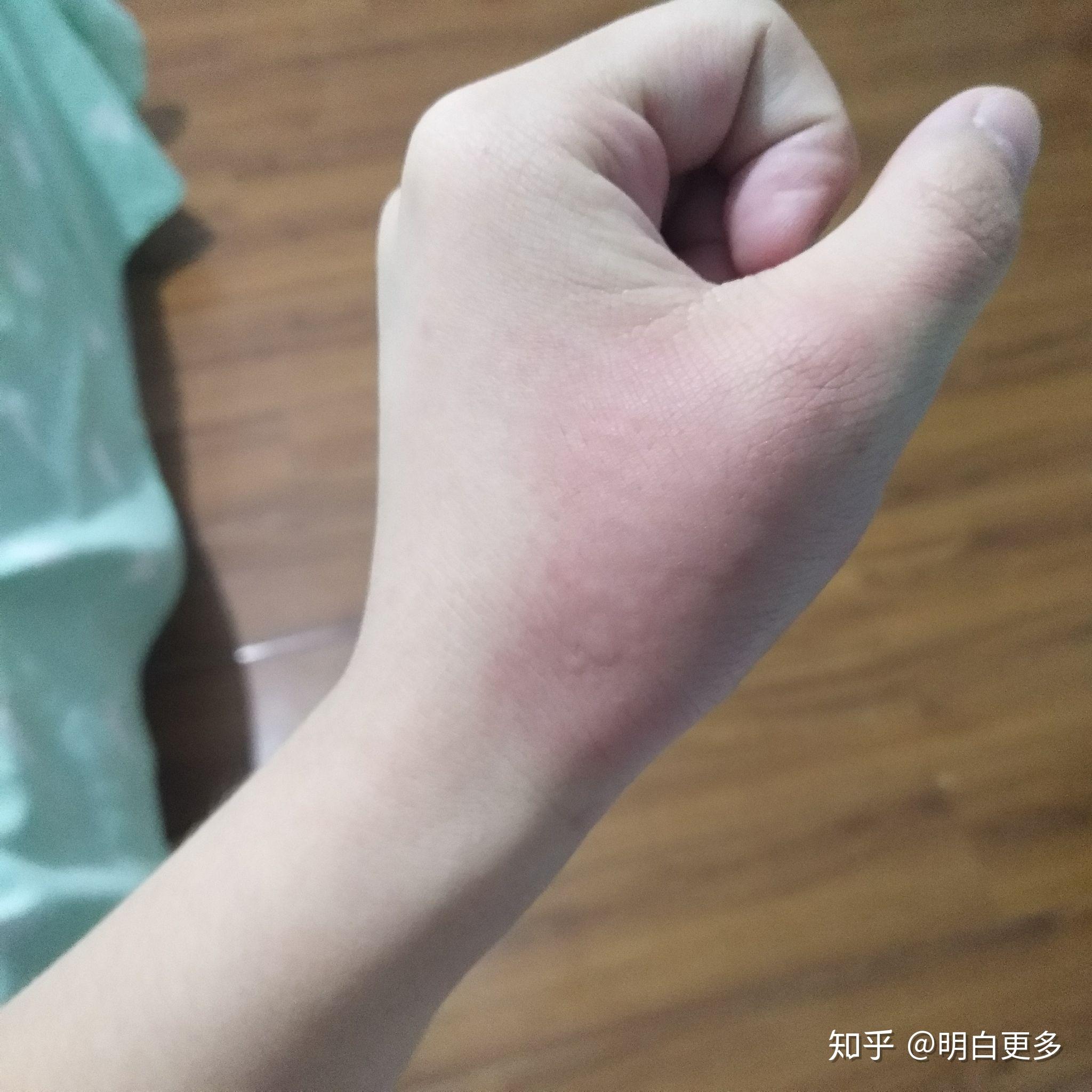 荨麻疹又复发了 最近压力有点大