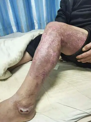 2020年烧伤疮疡在我科的发展