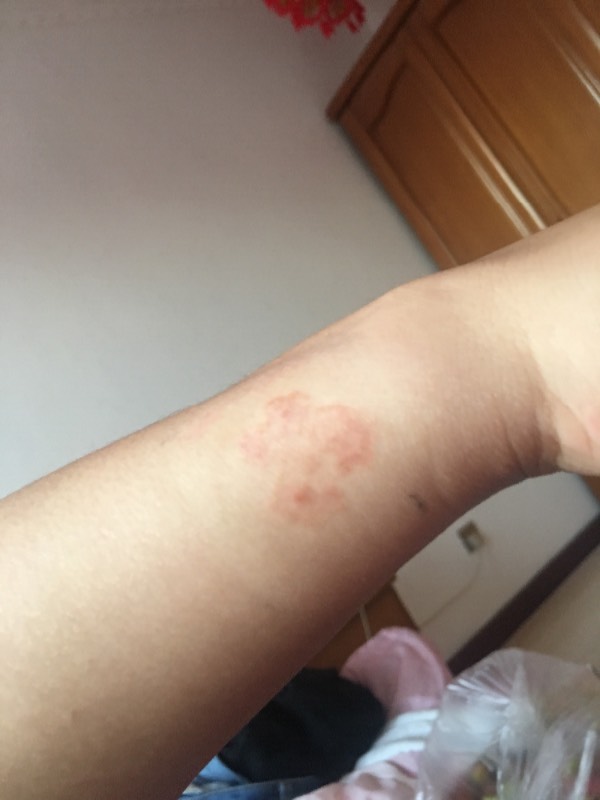 狗身上的癣会传染人吗