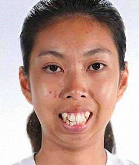 泰国19岁女孩因太丑找不到男友,整容后变成"大美女"!