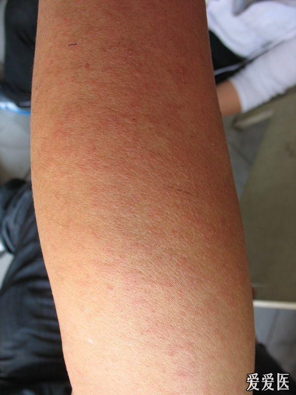 40多岁成人风疹一例