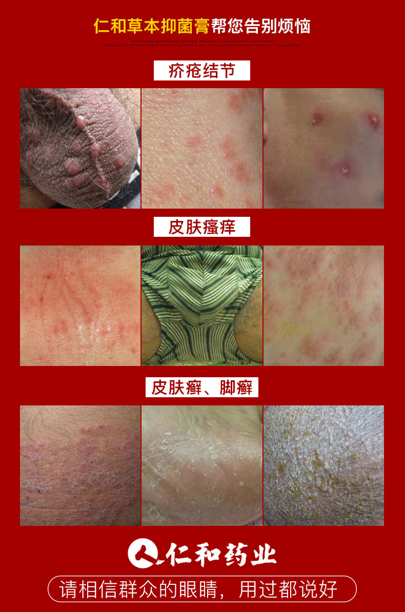 草本皮肤骚痒外用大腿内侧阴囊止痒股廯肛门真菌克星毛囊炎抑菌膏