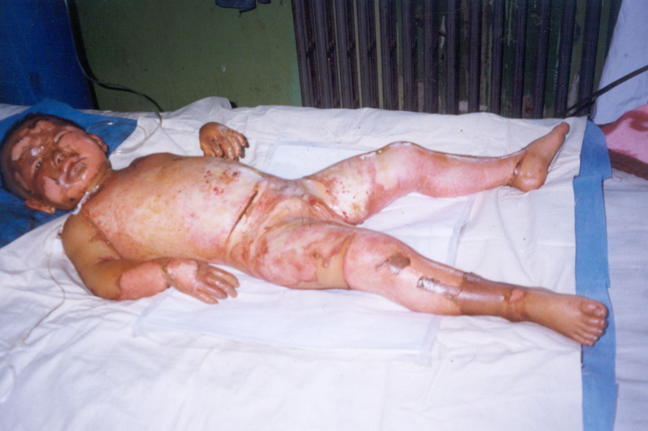 病例一,4 岁,回族,95%全身大面积烧伤深Ⅱ度45%,深Ⅲ度40%,浅Ⅲ度10%