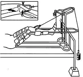 用于腰椎间盘突出症,牵引重量因人而异,一般7～15kg;③骨盆悬吊带