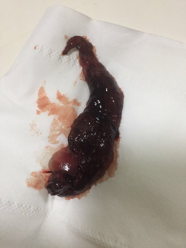 尝试自然流产的患者在组织排出后最好留存照片,旁边放打火机当做参照