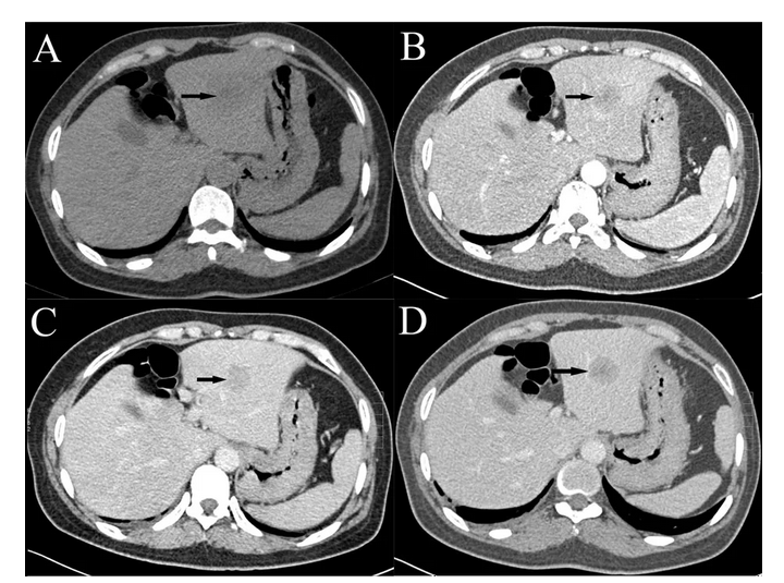 新英格兰医学杂志,最新发布详细的肝细胞癌综述