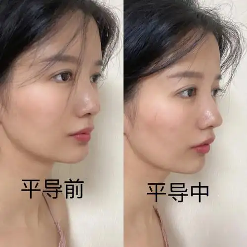 正畸日记整牙半年了开始戴平导了