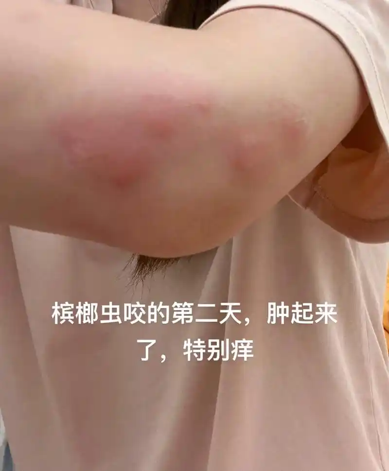 发现神奇药膏,蚊虫叮咬特别管用,有能刷到的可以试一下.槟榔虫 - 抖音