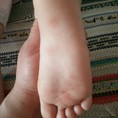 我家宝贝脚底有好多红色点点,也不痒,现在确定不了是什麼?_宝宝树