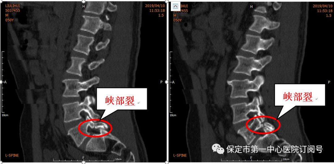 临床视点骨二科成功开展腰椎双侧峡部裂植骨修复手术