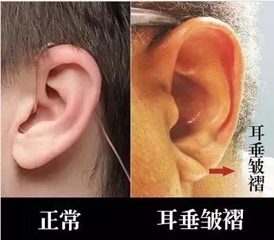 1,鼻梁长皱纹(鼻褶心征) 很多人在鼻梁根部,也就是两眼的中间,会有